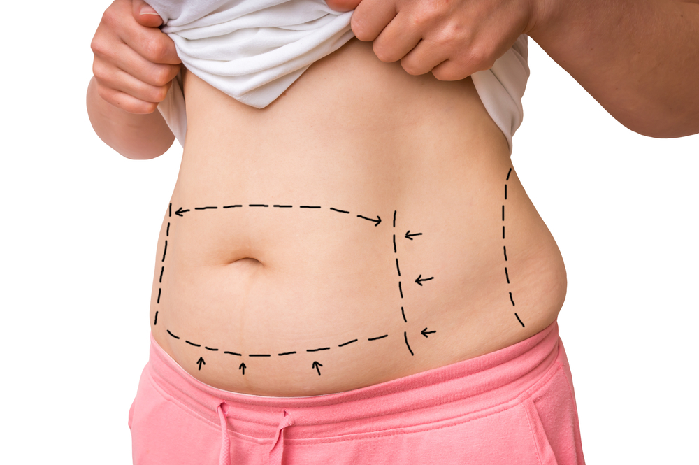 Laser Liposuction
