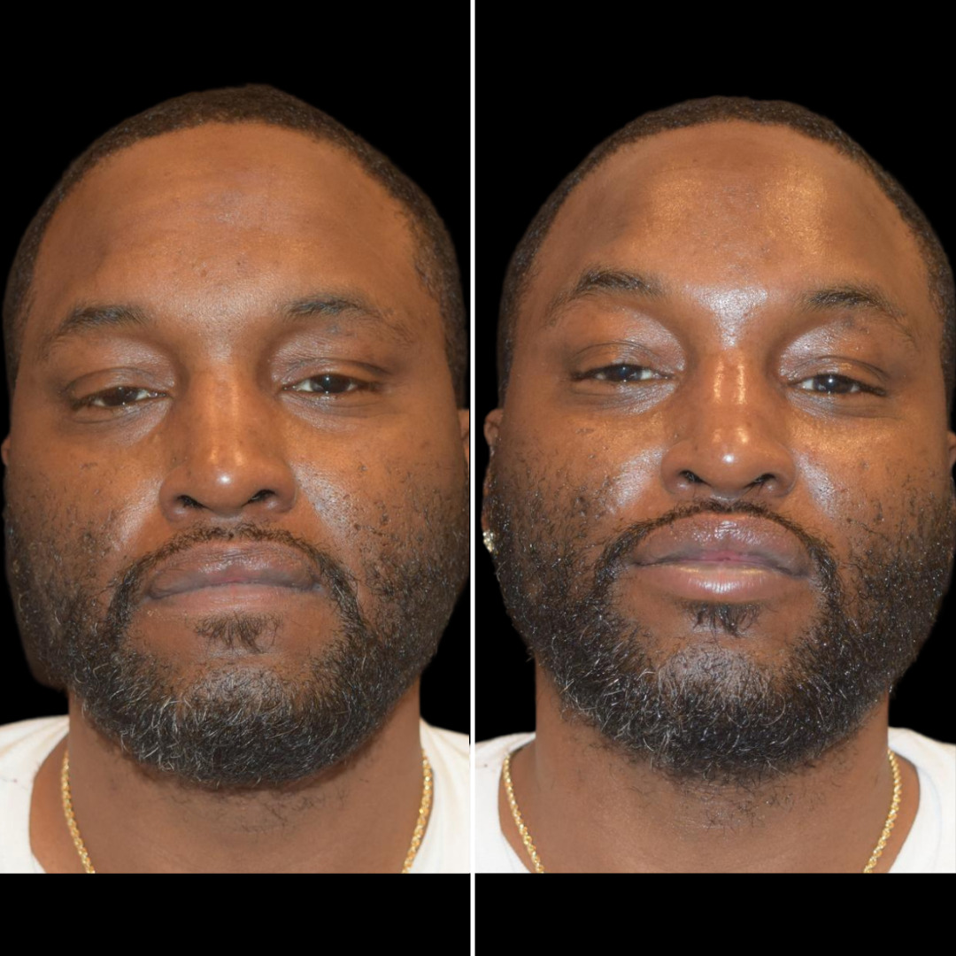 HydraFacial (23)