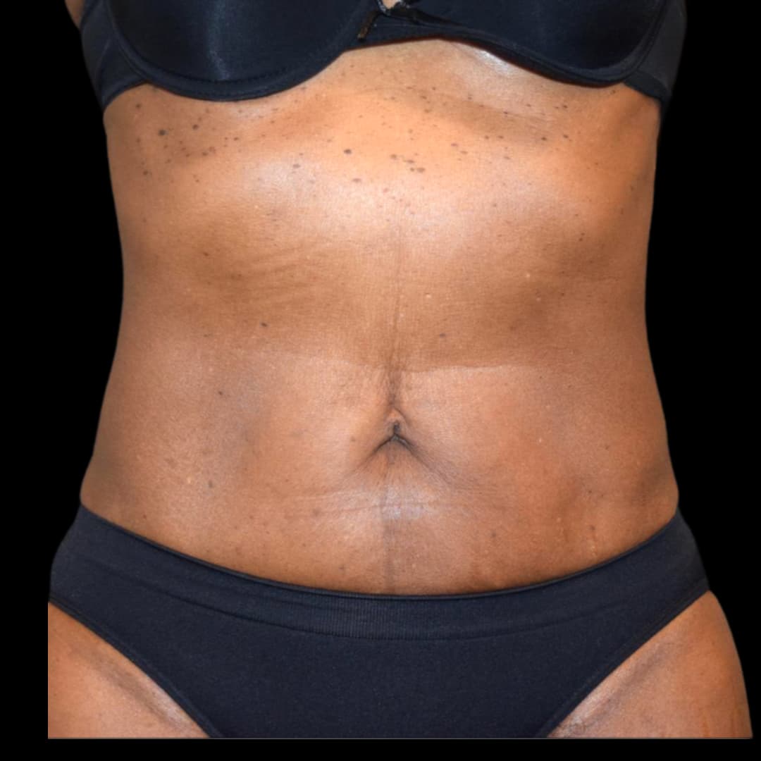 Emsculpt (After 6 Treatments) (2)