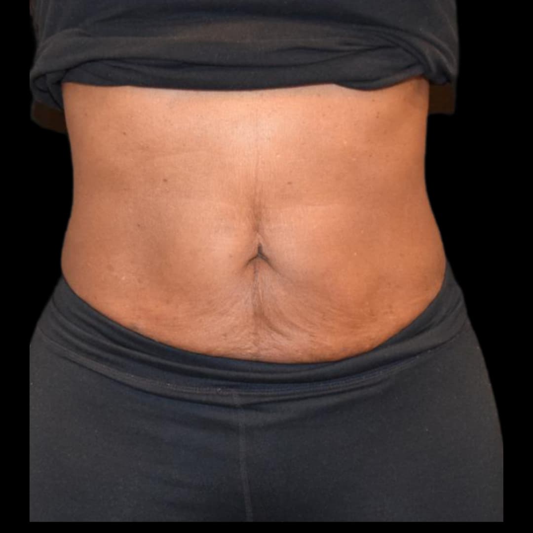 Emsculpt (Before - Abs)
