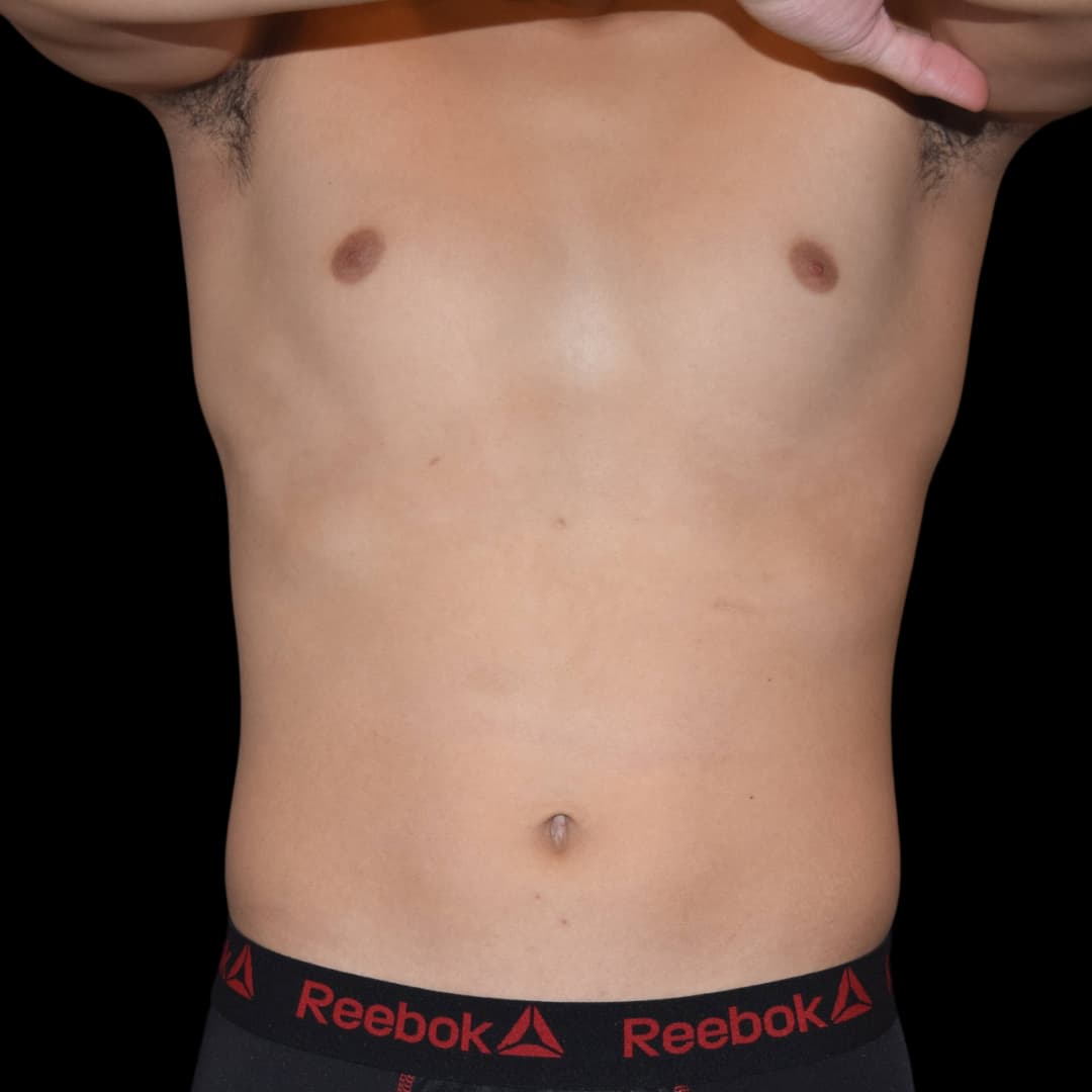 Emsculpt (Before)